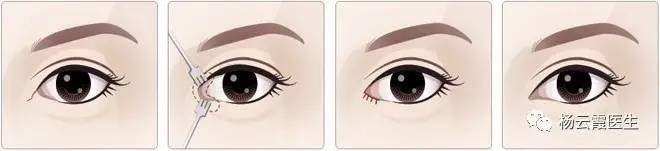 開內(nèi)眼角要多少錢 各地區(qū)不統(tǒng)一 開內(nèi)眼角要多少錢 各地區(qū)不統(tǒng)一