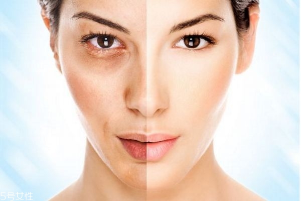 美白針可以自己打嗎 美白針的注意事項 美白針可以自己打嗎 美白針的注意事項