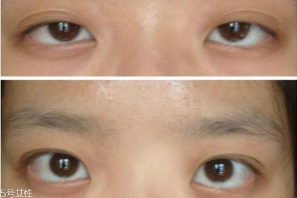 眼瞼下垂能治療嗎 眼瞼下垂治療方法 眼瞼下垂能治療嗎 眼瞼下垂治療方法
