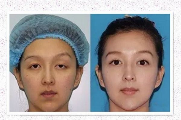 眼瞼下垂能治療嗎 眼瞼下垂治療方法 眼瞼下垂能治療嗎 眼瞼下垂治療方法