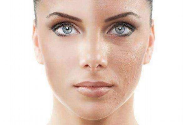 果酸換膚可以自己做嗎 果酸換膚用的什么酸