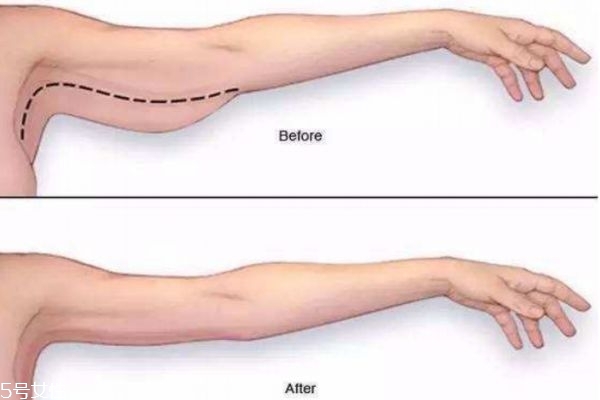 如何快速瘦手臂 減肥小妙招 如何快速瘦手臂 減肥小妙招