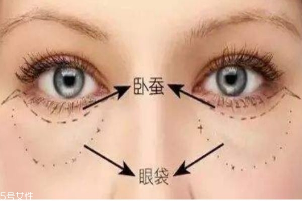 眼袋是怎么形成的呢 如何消除眼袋呢 眼袋是怎么形成的呢 如何消除眼袋呢