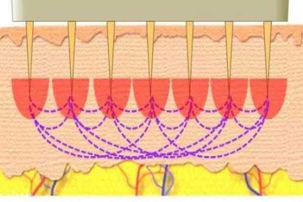 什么是微針呢 微針有什么作用呢 什么是微針呢 微針有什么作用呢