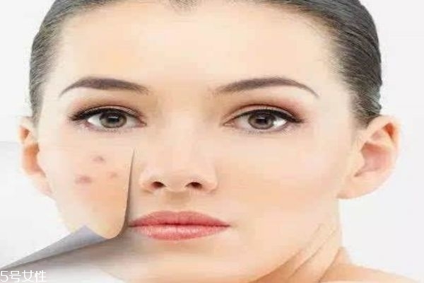 痘痘肌應(yīng)該用什么面膜呢 痘痘肌適合什么洗面奶呢 痘痘肌應(yīng)該用什么面膜呢 痘痘肌適合什么洗面奶呢