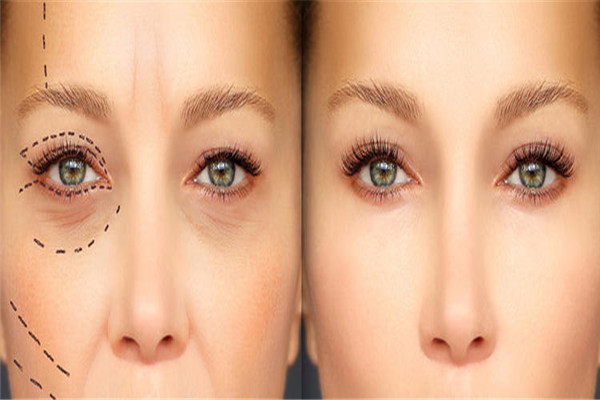 黑眼圈按摩儀有用嗎 黑眼圈要給眼睛適當(dāng)?shù)男菹r間