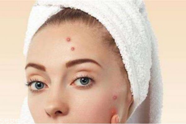 下巴兩側上長痘痘是什么原因 揪出下巴長痘的4個元兇