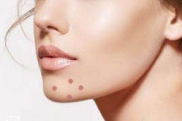 下巴兩側上長痘痘是什么原因 揪出下巴長痘的4個元兇
