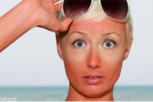 暴曬后怎么辦 暴曬后怎么處理 暴曬后怎么辦 暴曬后怎么處理