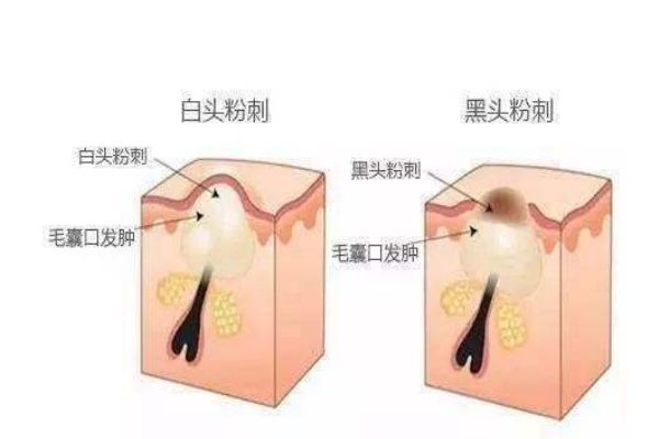 為什么會毛孔堵塞呢 毛孔堵塞有什么解決的辦法呢 為什么會毛孔堵塞呢 毛孔堵塞有什么解決的辦法呢