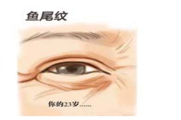 為什么會(huì)長(zhǎng)魚(yú)尾紋呢 怎么樣可以消除魚(yú)尾紋呢