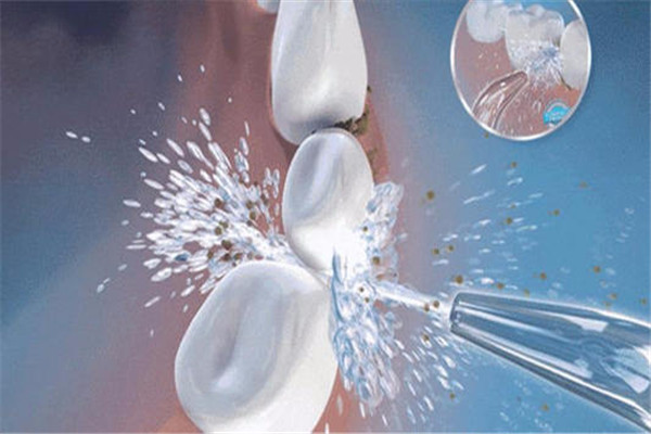 洗牙是否會傷害牙釉質(zhì) 洗牙是什么原理 洗牙是否會傷害牙釉質(zhì) 洗牙是什么原理