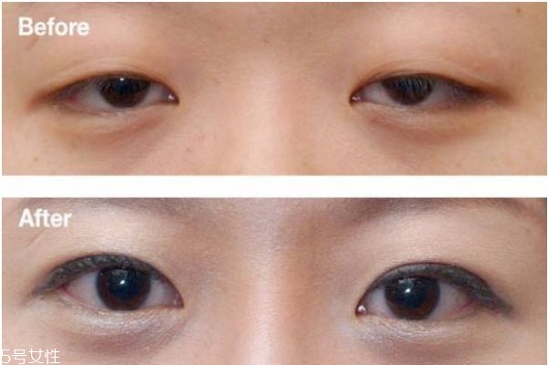 上瞼下垂矯正術治療方式 上瞼下垂矯正術優(yōu)點和缺點