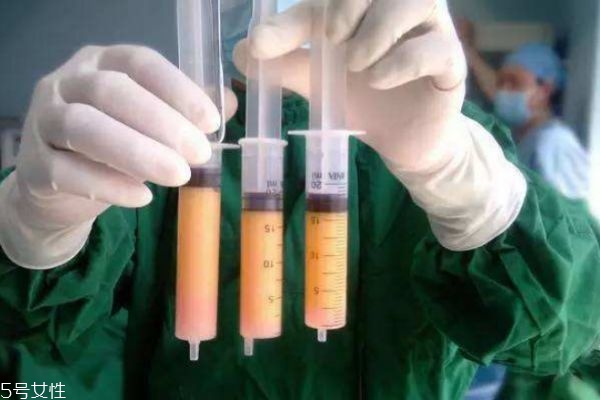 抽脂效果明顯嗎 抽脂效果好不好 抽脂效果明顯嗎 抽脂效果好不好