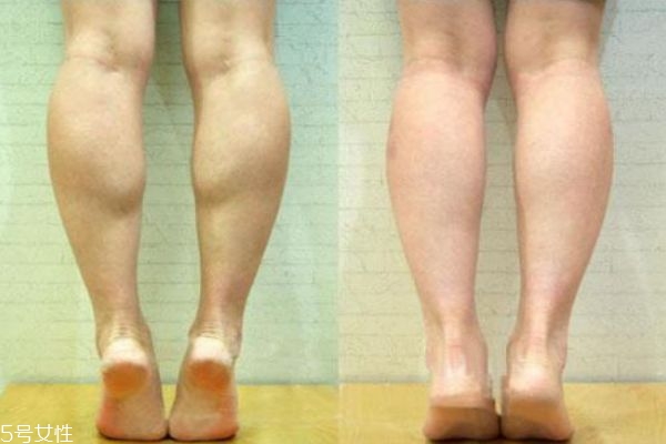 瘦腿針和抽脂瘦腿哪個(gè)好 瘦腿針好還是抽脂好 瘦腿針和抽脂瘦腿哪個(gè)好 瘦腿針好還是抽脂好