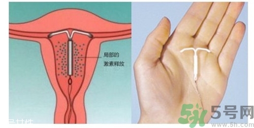 上環(huán)是什么意思？上環(huán)后注意事項(xiàng)有哪些？