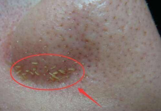 從鼻子上擠出來的白色東西是什么東西 4個(gè)去除方法 從鼻子上擠出來的白色東西是什么東西 4個(gè)去除方法