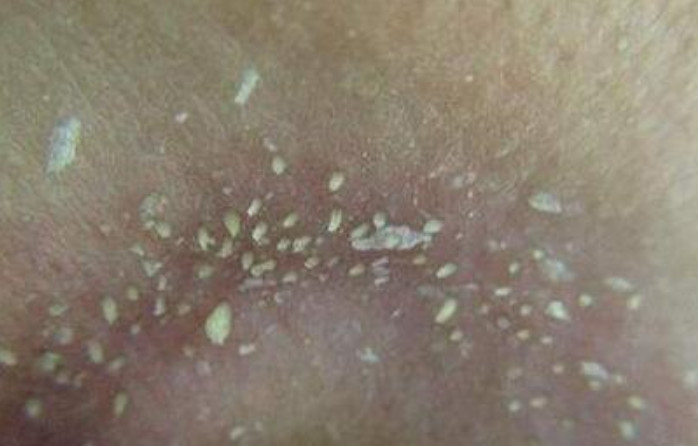 從鼻子上擠出來的白色東西是什么東西 4個(gè)去除方法 從鼻子上擠出來的白色東西是什么東西 4個(gè)去除方法