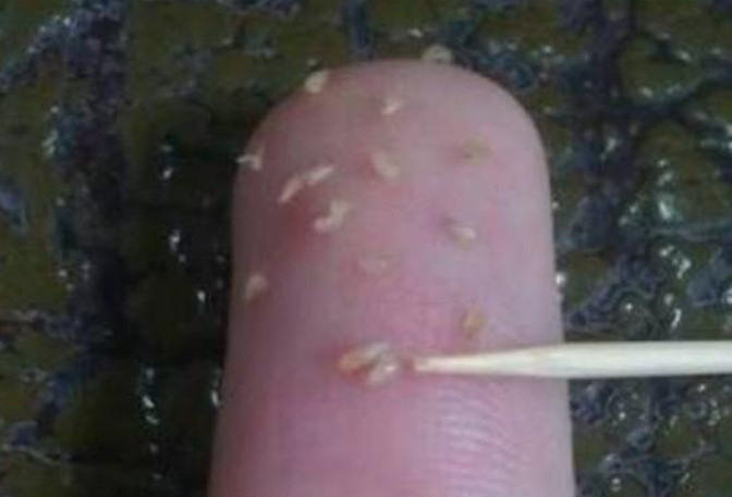 從鼻子上擠出來的白色東西是什么東西 4個(gè)去除方法 從鼻子上擠出來的白色東西是什么東西 4個(gè)去除方法