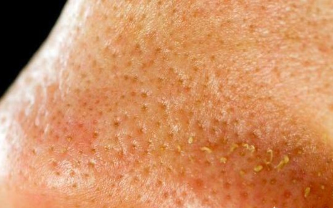 從鼻子上擠出來的白色東西是什么東西 4個(gè)去除方法 從鼻子上擠出來的白色東西是什么東西 4個(gè)去除方法