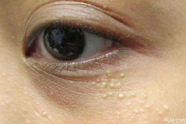 為什么涂眼霜會長脂肪粒呢 什么是脂肪粒呢 為什么涂眼霜會長脂肪粒呢 什么是脂肪粒呢