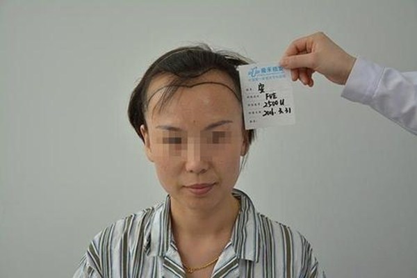 掉頭發(fā)很厲害怎么辦 掉頭發(fā)和脫發(fā)有什么區(qū)別 掉頭發(fā)很厲害怎么辦 掉頭發(fā)和脫發(fā)有什么區(qū)別