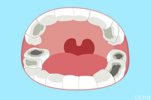 什么是蟲牙呢 蟲牙是怎么造成的呢 什么是蟲牙呢 蟲牙是怎么造成的呢