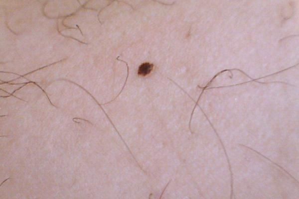 黑色素瘤是什么 什么原因會導(dǎo)致黑色素瘤