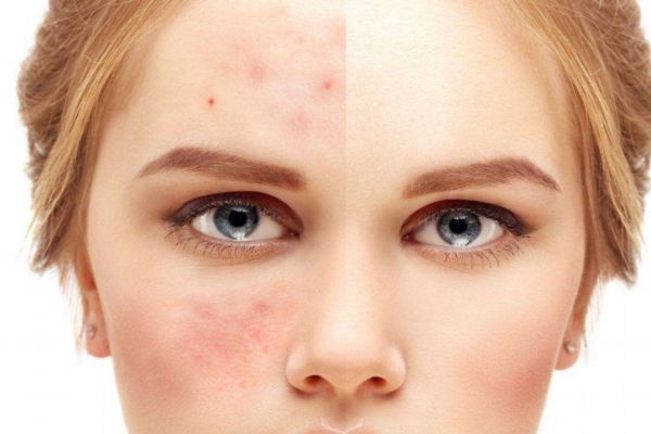 刷酸會爛臉嗎 應該怎么正確刷酸呢 刷酸會爛臉嗎 應該怎么正確刷酸呢