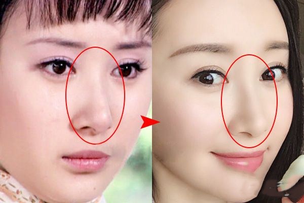 玻尿酸隆鼻會失敗嗎 玻尿酸隆鼻后的注意事項(xiàng) 玻尿酸隆鼻會失敗嗎 玻尿酸隆鼻后的注意事項(xiàng)