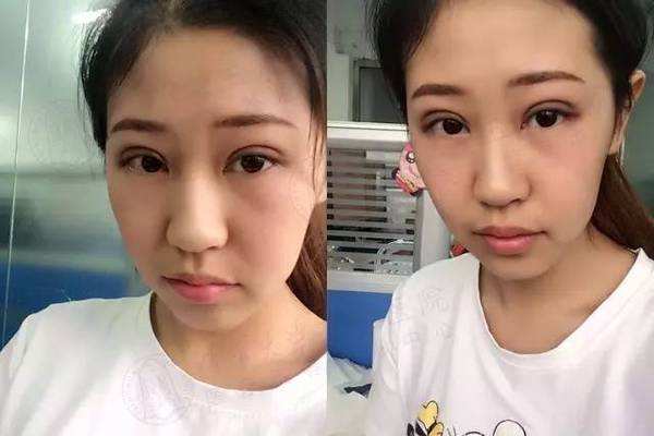 5s重瞼術(shù)有失敗的嗎 5s重瞼術(shù)的優(yōu)點(diǎn)有哪些 5s重瞼術(shù)有失敗的嗎 5s重瞼術(shù)的優(yōu)點(diǎn)有哪些