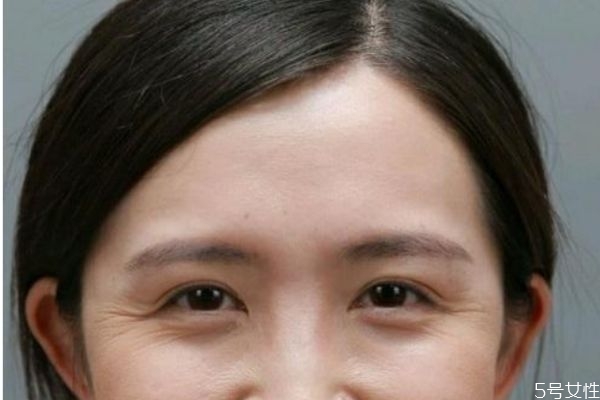 魚尾紋除皺多少錢呢 魚尾紋除皺需要注意什么呢 魚尾紋除皺多少錢呢 魚尾紋除皺需要注意什么呢