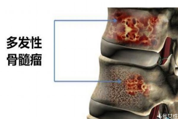 骨髓瘤造成的原因有什么呢 為什么會(huì)得骨髓瘤呢 骨髓瘤造成的原因有什么呢 為什么會(huì)得骨髓瘤呢