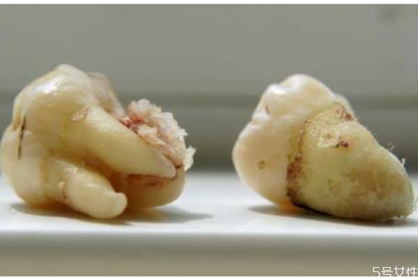 什么是智齒呢 每個(gè)人都會(huì)長(zhǎng)智齒嗎 什么是智齒呢 每個(gè)人都會(huì)長(zhǎng)智齒嗎