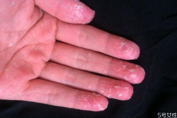 為什么手會(huì)脫皮呢 手脫皮是為什么呢 為什么手會(huì)脫皮呢 手脫皮是為什么呢