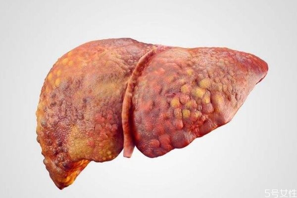肝硬化造成的原因有什么呢 為什么會(huì)得肝硬化呢 肝硬化造成的原因有什么呢 為什么會(huì)得肝硬化呢