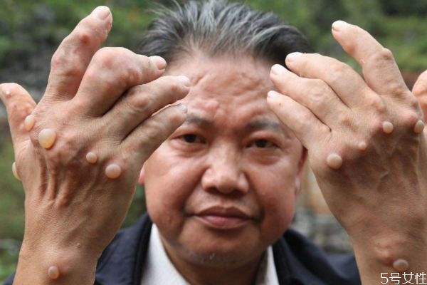 痛風造成的原因有什么 痛風應該怎么治療 痛風造成的原因有什么 痛風應該怎么治療