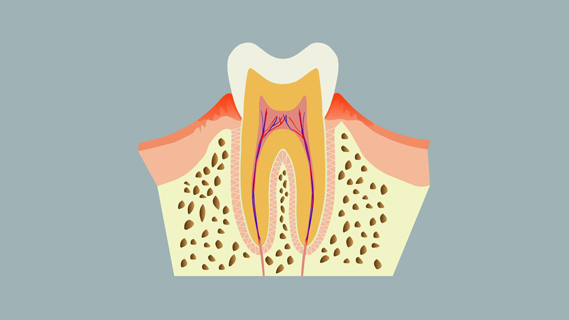 牙周炎要拔牙齒嗎 牙周炎要注意什么 牙周炎要拔牙齒嗎 牙周炎要注意什么