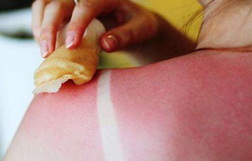 嚴(yán)重曬脫皮怎么護理 曬脫皮一周能好嗎