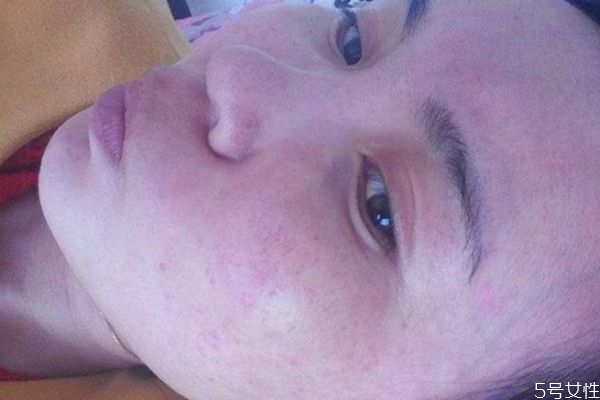 丹皮酚軟膏對脂溢性皮炎有用嗎 丹皮酚軟膏能治腳氣嗎