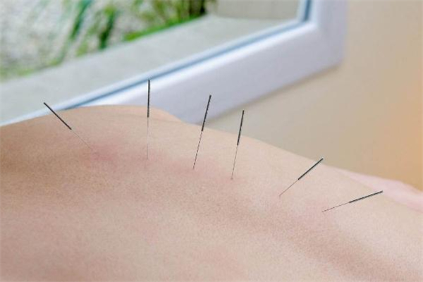 針灸減肥一個(gè)療程多少錢(qián) 針灸減肥一個(gè)療程是幾天