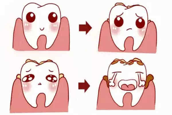 洗牙多久一次好 洗牙洗多了有害處嗎