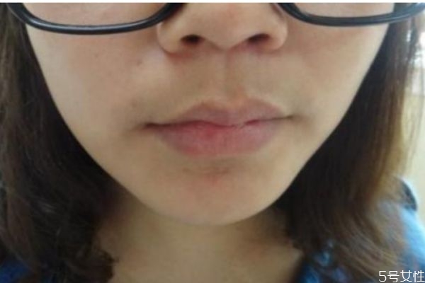 女性造成唇毛的原因是什么 為什么女性會(huì)長(zhǎng)唇毛