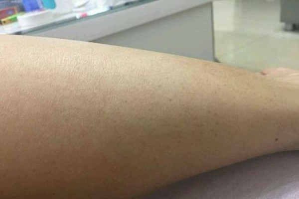 毛角周化好發(fā)于什么年齡 毛角周化什么年齡容易長 毛角周化好發(fā)于什么年齡 毛角周化什么年齡容易長