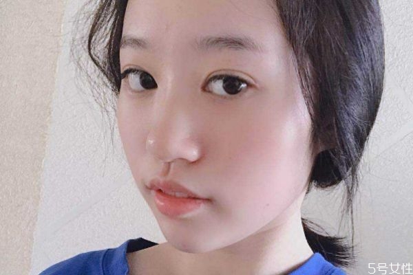 玻尿酸隆鼻后的注意事項 玻尿酸隆鼻后怎么護理 玻尿酸隆鼻后的注意事項 玻尿酸隆鼻后怎么護理