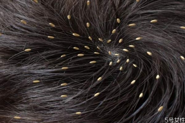 頭發(fā)容易出油怎么辦 頭發(fā)容易出油怎么解決 頭發(fā)容易出油怎么辦 頭發(fā)容易出油怎么解決