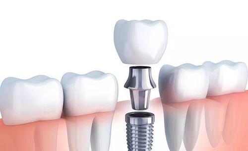 種植牙齒多少錢一顆 種植牙齒的價格受什么影響