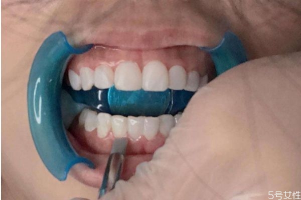 冰瓷美牙有什么危害 冰瓷美牙的副作用 冰瓷美牙有什么危害 冰瓷美牙的副作用
