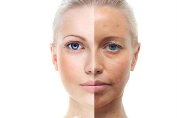 像束激光第幾天能好 像束激光的特點(diǎn) 像束激光第幾天能好 像束激光的特點(diǎn)