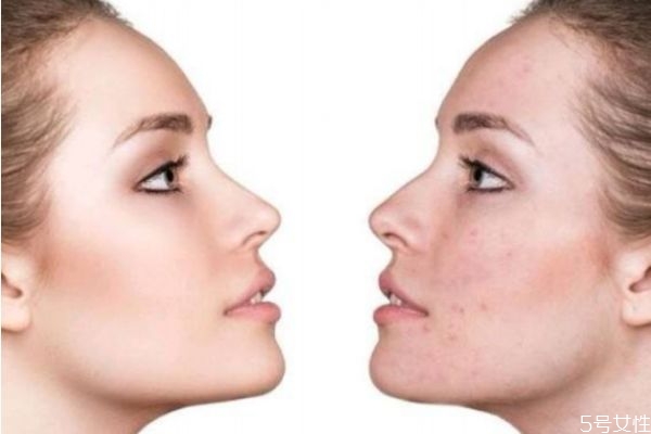 刷酸后皮膚脫皮是正常的嗎 刷酸的正確護(hù)膚步驟 刷酸后皮膚脫皮是正常的嗎 刷酸的正確護(hù)膚步驟